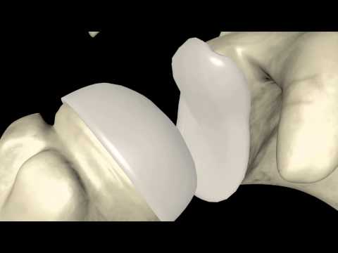 Schultergelenk Impingement Ursachen