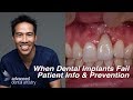 Dental Implant Failures - Patient Information and Prevention