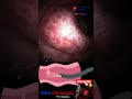 Coloscopy Colon Polyp Resection Polypectomy