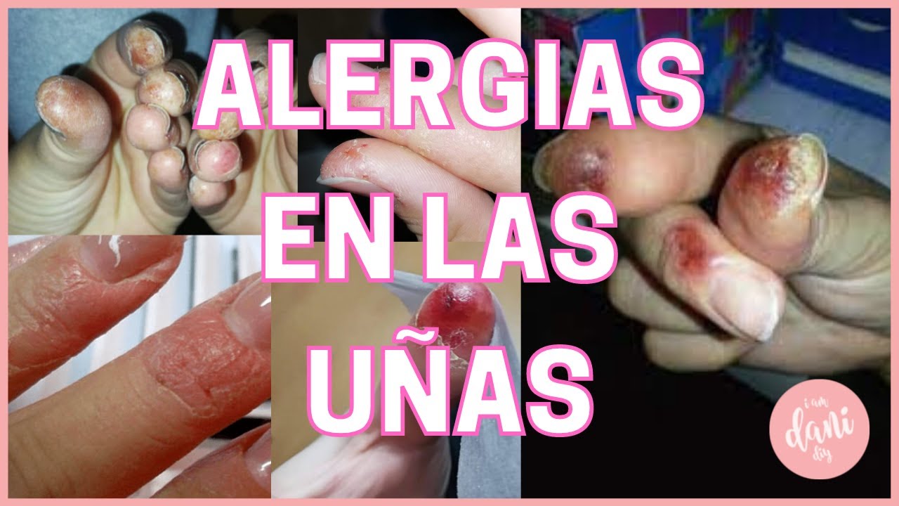 ??ALERGIAS a productos de UÑAS Dermatitis de contacto. ¿Por qué se produce