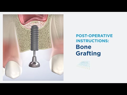 Post-Op: Bone Grafting in Modesto CA | Greater Modesto Dental Implant & Oral Surgery Center