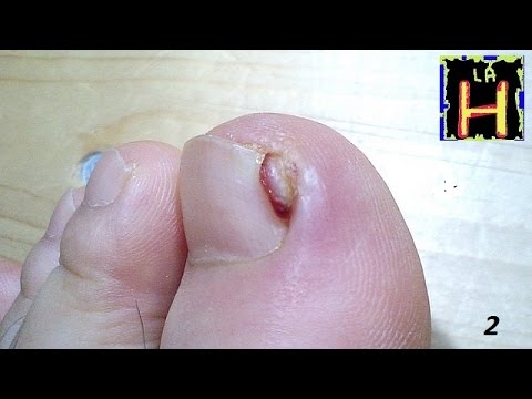 El preparado flukonazol al hongo de las uñas El ungüento del pellejo de cebolla del hongo de las uñas