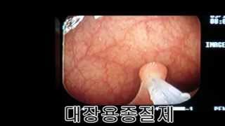 대장용종: 재검진