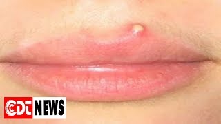 9 Simple Ways To Get Rid Of Pimples On Your Lips | CDT NEWS