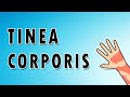 Tinea Corporis