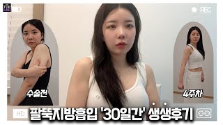 [팔뚝 지방흡입] 1개월, 생생한 브이로그