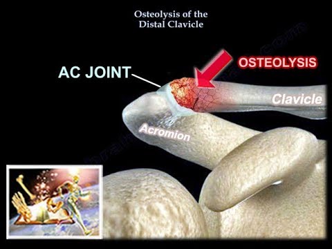 tratamentul artrozei articulației clavicular acromiale