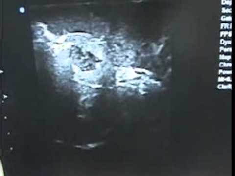 EnCor breast biopsy probe - 2007-08-18