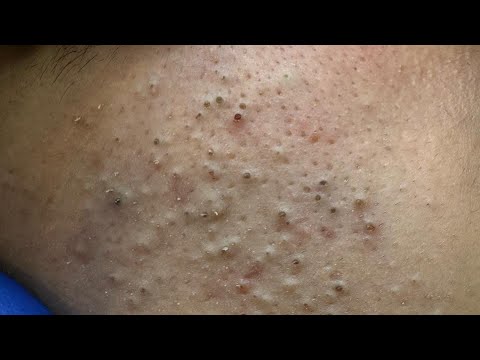 Soko Korean Skincare Routine (For Pimple Treatment & Acne Scar Removal)