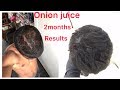 Best Hair Growth Result In 2 Months Using ONION JUICE Hairloss Hairgrowth Hair Trending Hairfall
