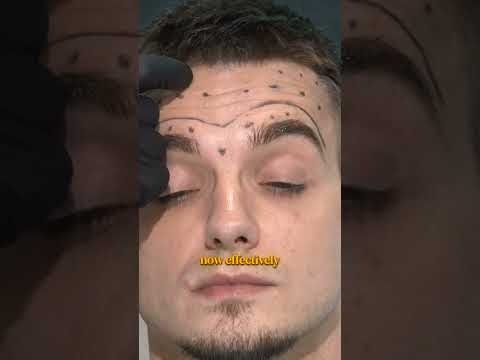 You need to know this before treating males with Botox 💉