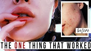 Clearing Hormonal Acne NATURALLY without Birth Control | Clear Skin NOT SPONSORED