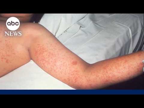 New measles death reported in Pennsylvania