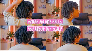 How to Get Rid of DRY ITCHY SCALP and Soothe Eczema/Dermatitis/Psoriasis (Starter Locs on 4C Hair)