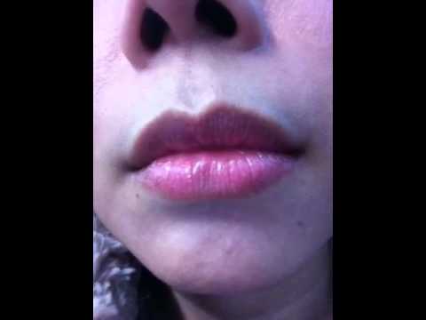ครีม salicylic การแสดงความคิดเห็นศีรษะโรคสะเก็ดเงิน อาหารโรคสะเก็ดเงินทุกวัน