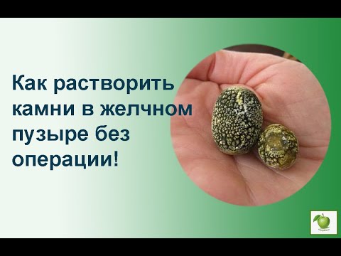 Как растворить камни в желчном пузыре без операции!