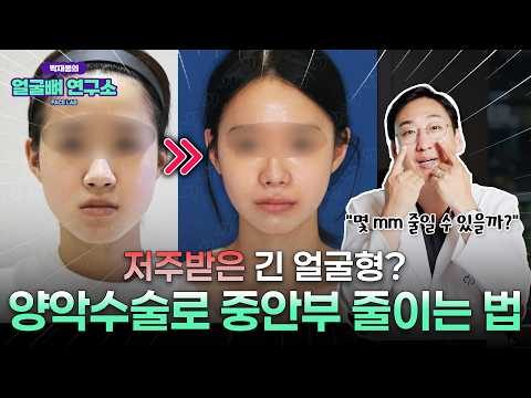 저주받은 얼굴형 1위? 중안부 긴 얼굴, 양악수술로 줄일 수 있을까?