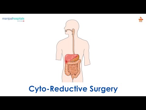 What is Cyto-Reductive Surgery (CRS)? l Manipal Hospitals Bengaluru