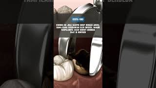 Download lagu Risiko yang terjadi bila sisa akar gigi tidak segera dicabut #cabutgigi #gigiberlubang #akargigi mp3 Download lagu Risiko yang terjadi bila sisa akar gigi tidak segera dicabut #cabutgigi #gigiberlubang #akargigi mp3