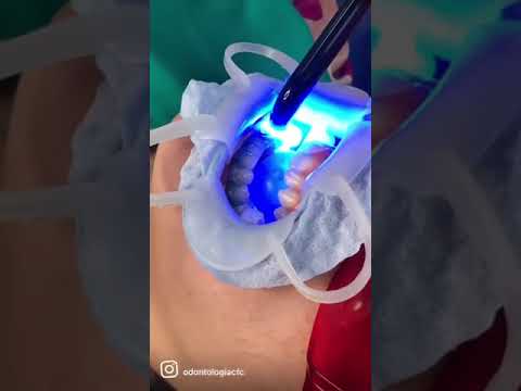 Teeth whitening at CFC Barranquilla Colombia