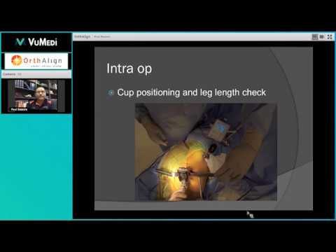 HipAlign lateral approach - Improving Posterolateral THA Outcomes Presentation - Dr. Paul Sasaura
