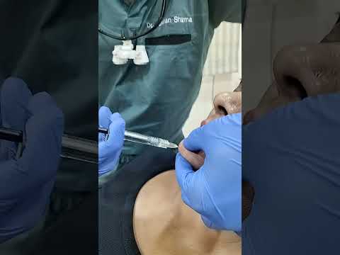 chin fillers Non surgical chin shaping