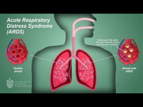 ARDS 2 pathophysiology VD