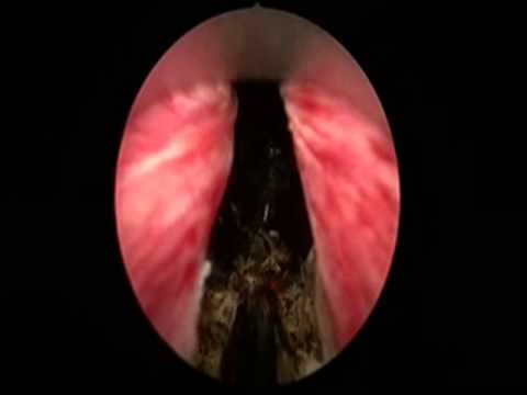 Prostata für Hämorrhoiden Physikalische Therapie für die Behandlung von Prostatitis
