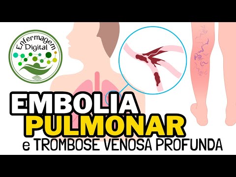 Pulmonary Embolism and Deep Vein Thrombosis - Learn to recognize their main characteristics.