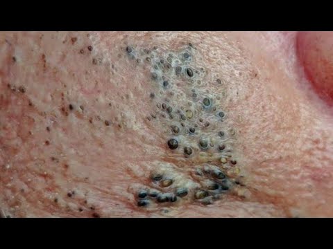 Deep blackhead Removal 2026, acne removal spa, big pimple 2026, #acne #pimple #cyst