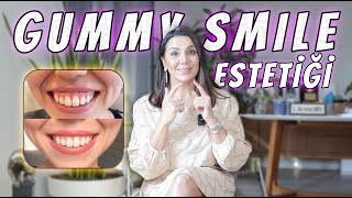 GUMMY SMİLE ESTETİĞİ?! | DİŞ ETİ GÖRÜNTÜSÜNÜ AZALTMAK!