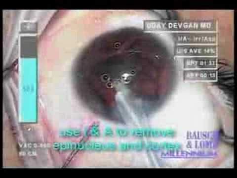 Posterior Polar Cataract Surgery