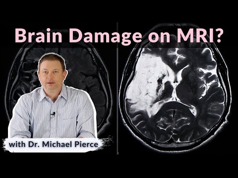 Will brain damage show on MRI?