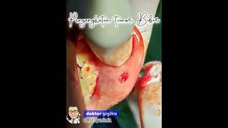 Download lagu Pengangkatan tumor bibir (traumatic fibroma) mp3 Download lagu Pengangkatan tumor bibir (traumatic fibroma) mp3