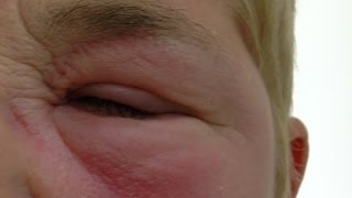 Treatment of gross eye swelling following an insect bite