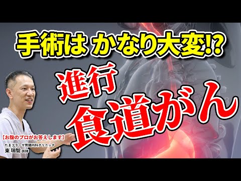 食道がんについて詳しく解説