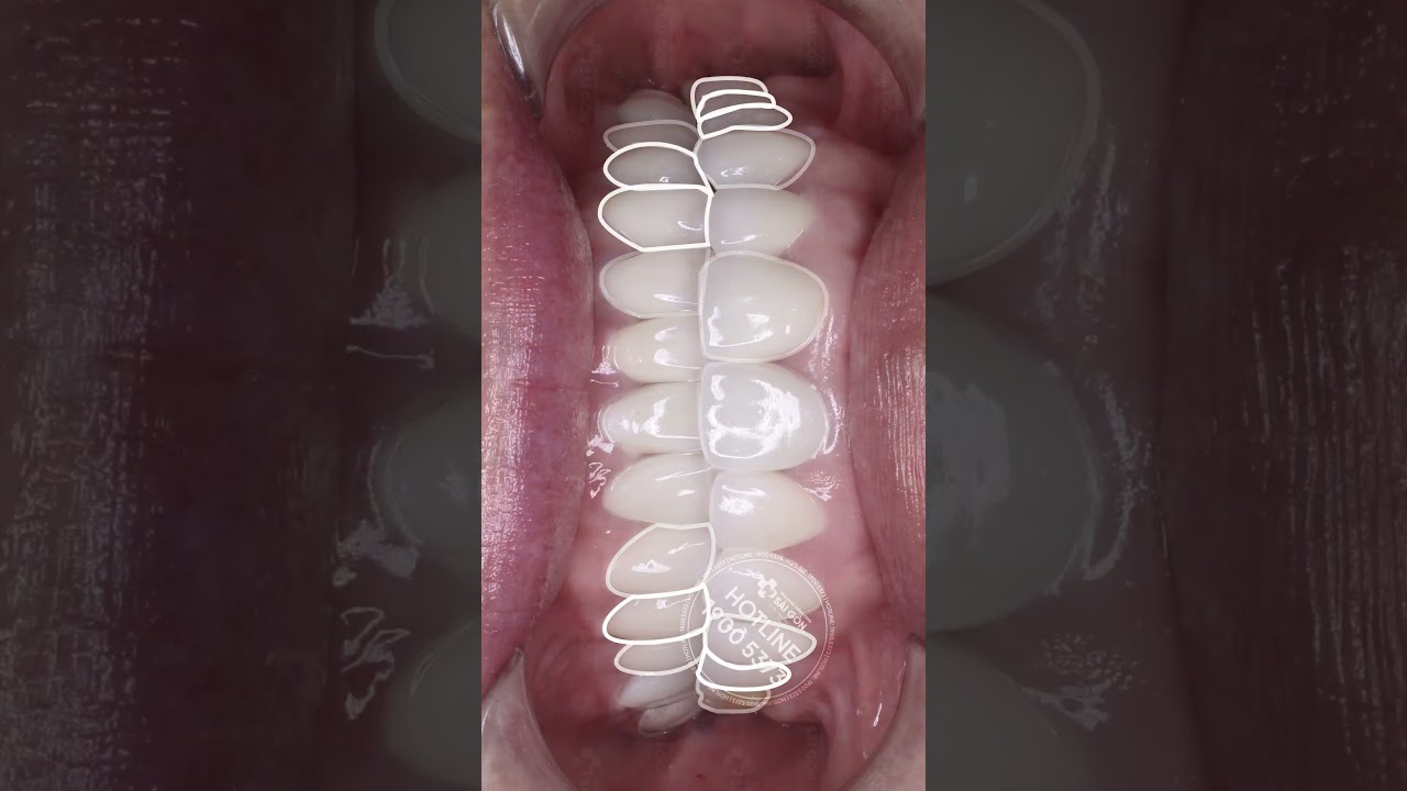 Case 25 Răng Toàn Sứ Lava Plus Khắc Phục Hở Sứ, Sứ Mòn, Ngả Màu | Nha Khoa Trồng Răng Sài Gòn