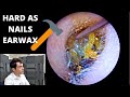 HARD AS NAILS Ear Wax VS Cawthorne Hook