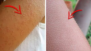 Do You Have Those Tiny Bumps on Your Arms? Here