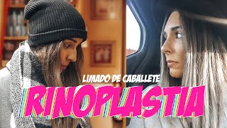 Limado de Caballete Anestesia Local | Limado de Caballete Antes y Después