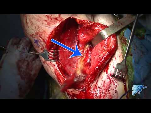 Patch-Augmented Latissimus Dorsi Transfer | Rotator Cuff Tear Treatment