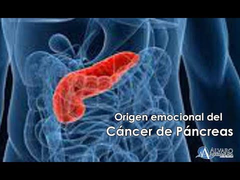Cancer colon pathology