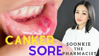 How do we get rid of Canker Sores, Mouth Ulcer FAST ! Prevention & Treatment!