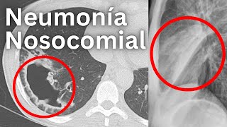 Neumonía Nosocomial Explicado Claramente