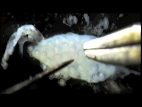 Fascioliasis invázió forrása Glistovye invázió a májban