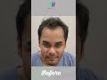 Unbelievable Hair Transplant Results At Medlinks Shorts Shortsfeed Viral