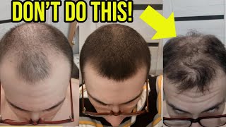 THE #1 THING YOU SHOULD NEVER DO WHILE ON HAIR LOSS TREATMENT! (WARNING)