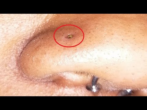 Nose Ring Sinking