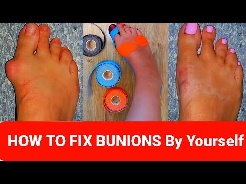 HOW to Fix  Bunions in 5 minutes | Kinesiology Taping for Hallux Valgus full tutorial