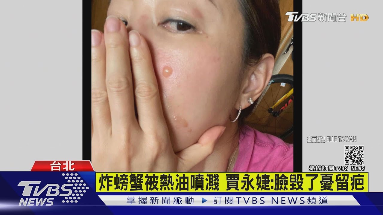 炸螃蟹被熱油噴濺　賈永婕：臉毀了憂留疤